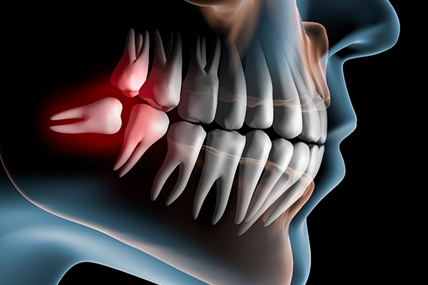 Extraction des dents de sagesse au Centre dentaire à Paris 9